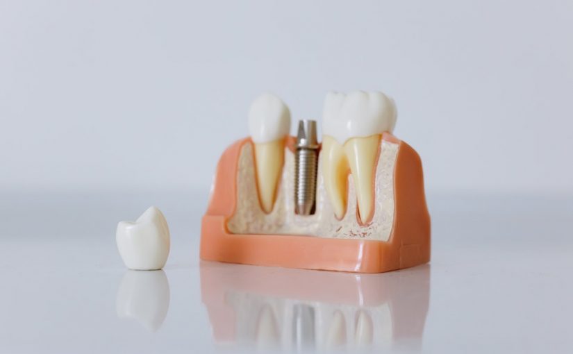 Cât costă un implant dentar în România? Avantaje și sfaturi practice